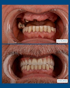 Рехабилитация на горна челюст с 6 импланта Osstem, поддържащи Торонто конструкция (Toronto framework) с циркониеви корони. Това протетично решение цели функционална рехабилитация чрез повишаване на биомеханичната устойчивост и осигуряване на балансирано разпределение на оклузалните сили.